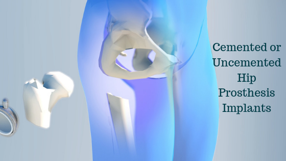 Cemented hip replacement improves quality of life for patients