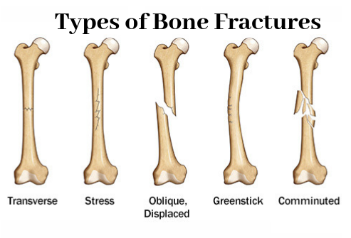 Different Types Of Fractures